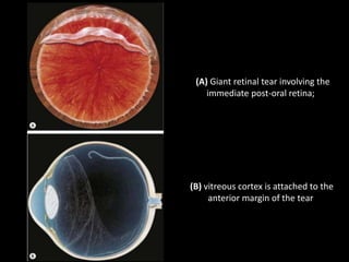 (A) Giant retinal tear involving the
immediate post-oral retina;
(B) vitreous cortex is attached to the
anterior margin of the tear
 