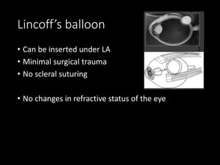 Lincoff’s balloon
• Can be inserted under LA
• Minimal surgical trauma
• No scleral suturing
• No changes in refractive status of the eye
 