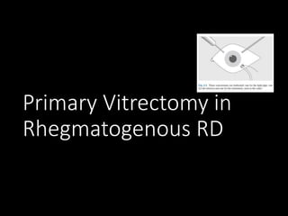 Primary Vitrectomy in
Rhegmatogenous RD
 