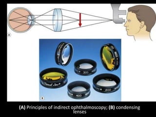 (A) Principles of indirect ophthalmoscopy; (B) condensing
lenses
 
