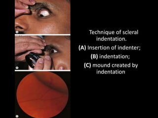 Technique of scleral
indentation.
(A) Insertion of indenter;
(B) indentation;
(C) mound created by
indentation
 