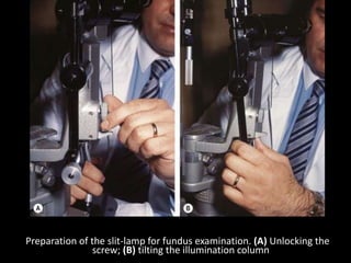 Preparation of the slit-lamp for fundus examination. (A) Unlocking the
screw; (B) tilting the illumination column
 