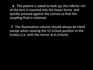 e The patient is asked to look up; the inferior rim
of the lens is inserted into the lower fornix and
quickly pressed against the cornea so that the
coupling fluid is retained.
f The illumination column should always be tilted
except when viewing the 12 o’clock position in the
fundus (i.e. with the mirror at 6 o’clock).
 