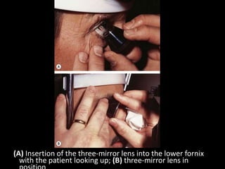 (A) Insertion of the three-mirror lens into the lower fornix
with the patient looking up; (B) three-mirror lens in
 