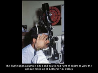 The illumination column is tilted and positioned right of centre to view the
oblique meridian at 1.30 and 7.30 o’clock
 