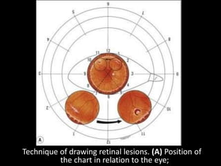 Technique of drawing retinal lesions. (A) Position of
the chart in relation to the eye;
 