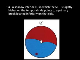 • a A shallow inferior RD in which the SRF is slightly
higher on the temporal side points to a primary
break located inferiorly on that side.
 