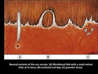 Normal variants of the ora serrata. (A) Meridional fold with a small retinal
hole at its base; (B) enclosed oral bay; (C) granular tissue
 