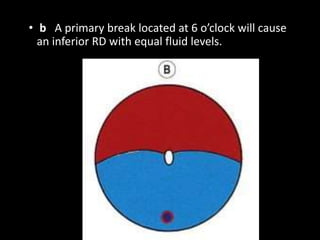 • b A primary break located at 6 o’clock will cause
an inferior RD with equal fluid levels.
 