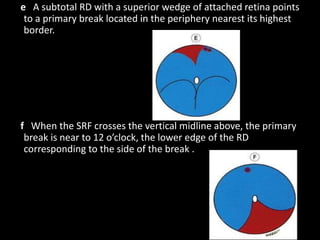 e A subtotal RD with a superior wedge of attached retina points
to a primary break located in the periphery nearest its highest
border.
f When the SRF crosses the vertical midline above, the primary
break is near to 12 o’clock, the lower edge of the RD
corresponding to the side of the break .
 