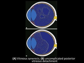 (A) Vitreous syneresis; (B) uncomplicated posterior
vitreous detachment
 