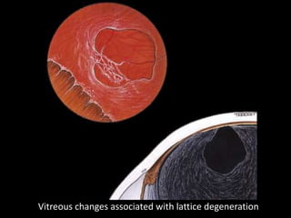 Vitreous changes associated with lattice degeneration
 
