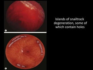 Islands of snailtrack
degeneration, some of
which contain holes
 