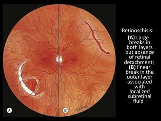 Retinoschisis.
(A) Large
breaks in
both layers
but absence
of retinal
detachment;
(B) linear
break in the
outer layer
associated
with
localized
subretinal
fluid
 
