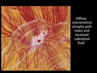Diffuse
chorioretinal
atrophy with
holes and
localized
subretinal
fluid
 