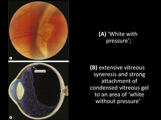 (A) ‘White with
pressure’;
(B) extensive vitreous
syneresis and strong
attachment of
condensed vitreous gel
to an area of ‘white
without pressure’
 