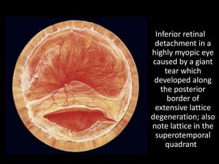 Inferior retinal
detachment in a
highly myopic eye
caused by a giant
tear which
developed along
the posterior
border of
extensive lattice
degeneration; also
note lattice in the
superotemporal
quadrant
 