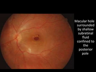 Macular hole
surrounded
by shallow
subretinal
fluid
confined to
the
posterior
pole
 