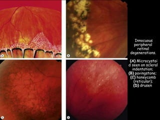 Innocuous
peripheral
retinal
degenerations.
(A) Microcystoi
d seen on scleral
indentation;
(B) pavingstone;
(C) honeycomb
(reticular);
(D) drusen
 