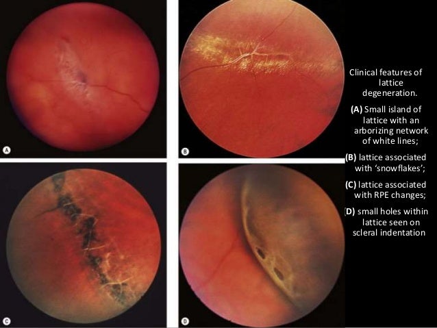 symptoms of lattice degeneration symptoms of lattice degeneration
