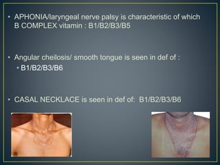 • APHONIA/laryngeal nerve palsy is characteristic of which
B COMPLEX vitamin : B1/B2/B3/B5
• Angular cheilosis/ smooth tongue is seen in def of :
• B1/B2/B3/B6
• CASAL NECKLACE is seen in def of: B1/B2/B3/B6
 