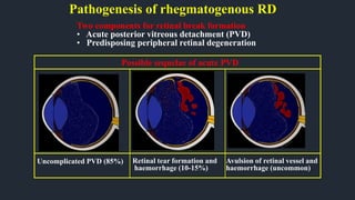 Pathogenesis of rhegmatogenous RD
Possible sequelae of acute PVD
Two components for retinal break formation
• Acute posterior vitreous detachment (PVD)
• Predisposing peripheral retinal degeneration
Uncomplicated PVD (85%) Retinal tear formation and
haemorrhage (10-15%)
Avulsion of retinal vessel and
haemorrhage (uncommon)
 