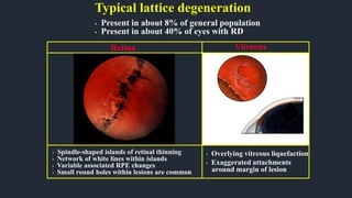 Typical lattice degeneration
• Present in about 8% of general population
• Present in about 40% of eyes with RD
• Spindle-shaped islands of retinal thinning
• Network of white lines within islands
• Variable associated RPE changes
• Small round holes within lesions are common
• Overlying vitreous liquefaction
• Exaggerated attachments
around margin of lesion
Retina Vitreous
 