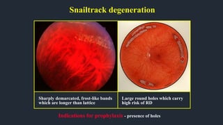 Snailtrack degeneration
Indications for prophylaxis - presence of holes
Sharply demarcated, frost-like bands
which are longer than lattice
Large round holes which carry
high risk of RD
 