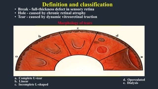• Break - full-thickness defect in sensory retina
• Hole - caused by chronic retinal atrophy
• Tear - caused by dynamic vitreoretinal traction
d. Operculated
e. Dialysis
Morphology of tears
a. Complete U-tear
b. Linear
c. Incomplete L-shaped
Definition and classification
 