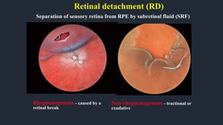 Retinal detachment (RD)
Separation of sensory retina from RPE by subretinal fluid (SRF)
Rhegmatogenous - caused by a
retinal break
Non-rhegmatogenous - tractional or
exudative
 