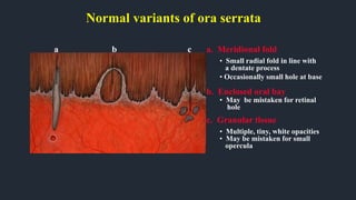 Normal variants of ora serrata
a. Meridional fold
• Small radial fold in line with
a dentate process
• Occasionally small hole at base
b. Enclosed oral bay
• May be mistaken for retinal
hole
c. Granular tissue
• Multiple, tiny, white opacities
• May be mistaken for small
opercula
a c
b
 