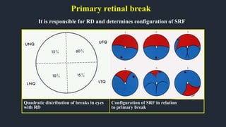 Primary retinal break
It is responsible for RD and determines configuration of SRF
Quadratic distribution of breaks in eyes
with RD
Configuration of SRF in relation
to primary break
 