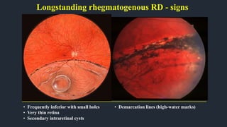 Longstanding rhegmatogenous RD - signs
• Frequently inferior with small holes
• Very thin retina
• Secondary intraretinal cysts
• Demarcation lines (high-water marks)
 