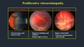 Proliferative vitreoretinopathy
• Vitreous haze and
tobacco dust
Grade A (minimal)
• Rigid retinal folds
• Vitreous condensations
and strands
Grade C (severe)
• Retinal wrinkling and
stiffness
• Rolled edges of tears
Grade B (moderate)
 