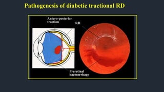 Pathogenesis of diabetic tractional RD
Antero-posterior
traction RD
Preretinal
haemorrhage
 