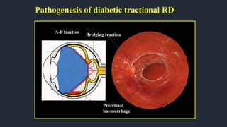 Pathogenesis of diabetic tractional RD
Bridging traction
A-P traction
Preretinal
haemorrhage
 