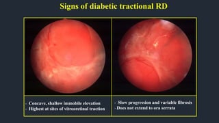 Signs of diabetic tractional RD
• Slow progression and variable fibrosis
• Does not extend to ora serrata
• Concave, shallow immobile elevation
• Highest at sites of vitreoretinal traction
 