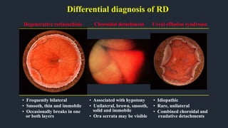 Differential diagnosis of RD
Degenerative retinoschisis
• Frequently bilateral
• Smooth, thin and immobile
• Occasionally breaks in one
or both layers
Choroidal detachment
• Associated with hypotony
• Unilateral, brown, smooth,
solid and immobile
• Ora serrata may be visible
Uveal effusion syndrome
• Idiopathic
• Rare, unilateral
• Combined choroidal and
exudative detachments
 