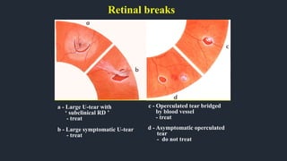 Retinal breaks
a - Large U-tear with
‘ subclinical RD ’
- treat
b - Large symptomatic U-tear
- treat
c - Operculated tear bridged
by blood vessel
- treat
d - Asymptomatic operculated
tear
- do not treat
 