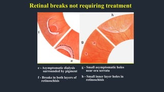 Retinal breaks not requiring treatment
e - Asymptomatic dialysis
surrounded by pigment
f - Breaks in both layers of
retinoschisis
g - Small asymptomatic holes
near ora serrata
h - Small inner layer holes in
retinoschisis
 