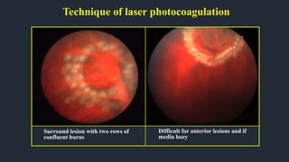 Technique of laser photocoagulation
Surround lesion with two rows of
confluent burns
Difficult for anterior lesions and if
media hazy
 