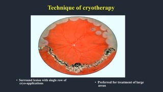 Technique of cryotherapy
• Surround lesion with single row of
cryo-applications • Preferred for treatment of large
areas
 