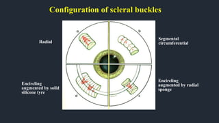 Configuration of scleral buckles
Radial
Segmental
circumferential
Encircling
augmented by radial
sponge
Encircling
augmented by solid
silicone tyre
 