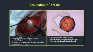 Localization of breaks
• Insert 5/0 Dacron scleral suture
at site of apex of break
• Grasp cut suture with curved mosquito
forceps close to knot
• While viewing with indirect
ophthalmoscope check position of
indentation in relation to break
 