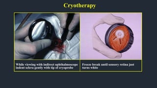 While viewing with indirect ophthalmoscope
indent sclera gently with tip of cryoprobe
Freeze break until sensory retina just
turns white
Cryotherapy
 