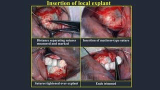 Insertion of local explant
Distance separating sutures
measured and marked
Ends trimmed
Sutures tightened over explant
Insertion of mattress-type suture
 