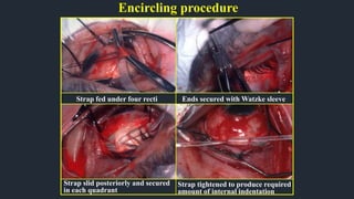 Encircling procedure
Strap fed under four recti Ends secured with Watzke sleeve
Strap slid posteriorly and secured
in each quadrant
Strap tightened to produce required
amount of internal indentation
 