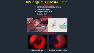 Drainage of subretinal fluid
Indications
Haemorrhage
• Difficulty in localizing break
• Immobile retina
• Longstanding RD
• Inferior RD
Retinal incarceration
Complications
Technique
 