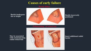 Causes of early failure
May be associated
with communicating
radial retinal fold
Insert additional radial
buckle
Buckle failure
‘ Fishmouthing ’ of retinal tear
Buckle inadequate
size or height
Buckle incorrectly
positioned
 