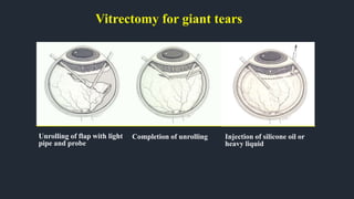 Vitrectomy for giant tears
Unrolling of flap with light
pipe and probe
Completion of unrolling Injection of silicone oil or
heavy liquid
 